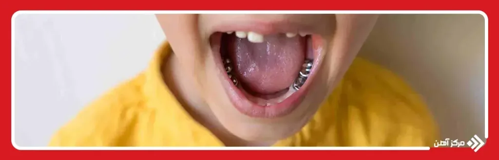 کاربرد روکش استیل ضد زنگ در دندانپزشکی